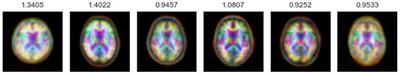 DeepAD: A deep learning application for predicting amyloid standardized uptake value ratio through PET for Alzheimer's prognosis